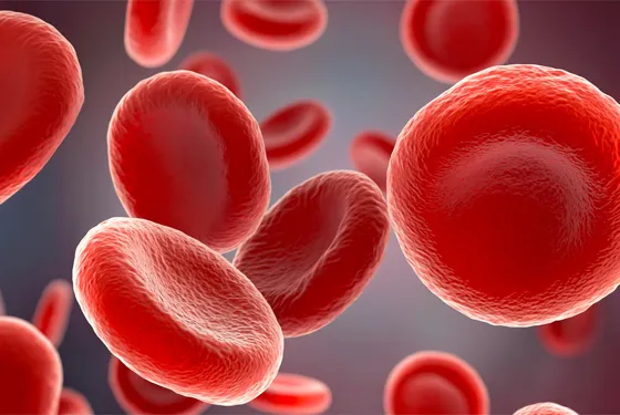 Globules rouges déformés caractéristiques de la drépanocytose, maladie génétique du sang