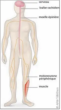 Infographie - Amyotrophie spinale - Motoneurone périphérique